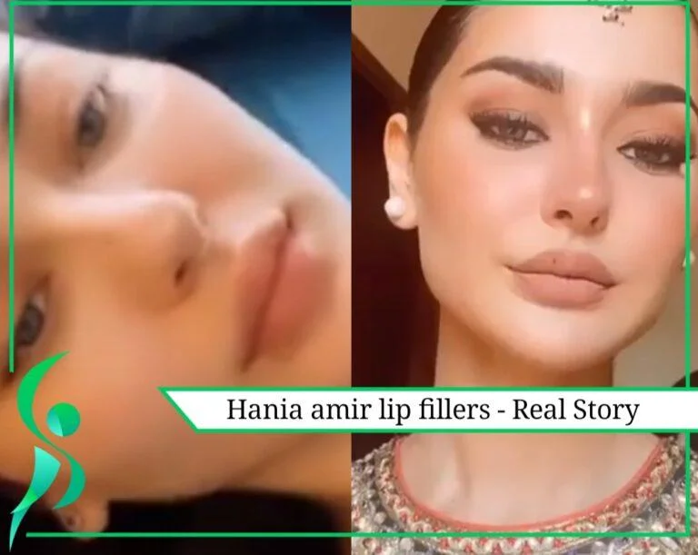 Hania Amir Lip Fillers: Truth behind it